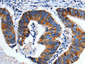 The image on the left is immunohistochemistry of paraffin-embedded Human colon cancer tissue using CSB-PA096500(CHRM2 Antibody) at dilution 1/3, on the right is treated with fusion protein. (Original magnification: ×200)