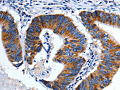 The image on the left is immunohistochemistry of paraffin-embedded Human colon cancer tissue using CSB-PA096500(CHRM2 Antibody) at dilution 1/3, on the right is treated with fusion protein. (Original magnification: ×200)