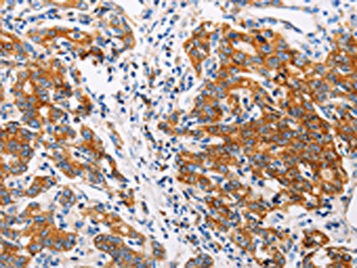 The image on the left is immunohistochemistry of paraffin-embedded Human gastic cancer tissue using CSB-PA096507(CTNNA1 Antibody) at dilution 1/35, on the right is treated with fusion protein. (Original magnification: ×200)