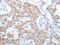 The image on the left is immunohistochemistry of paraffin-embedded Human lung cancer tissue using CSB-PA097333(CEACAM5 Antibody) at dilution 1/40, on the right is treated with synthetic peptide. (Original magnification: ×200)