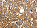 The image on the left is immunohistochemistry of paraffin-embedded Human thyroid cancer tissue using CSB-PA097385(SYT11 Antibody) at dilution 1/30, on the right is treated with fusion protein. (Original magnification: ×200)