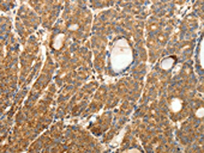 The image on the left is immunohistochemistry of paraffin-embedded Human thyroid cancer tissue using CSB-PA097385(SYT11 Antibody) at dilution 1/30, on the right is treated with fusion protein. (Original magnification: ×200)