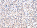 The image on the left is immunohistochemistry of paraffin-embedded Human esophagus cancer tissue using CSB-PA097487(ACOT1 Antibody) at dilution 1/30, on the right is treated with fusion protein. (Original magnification: ×200)