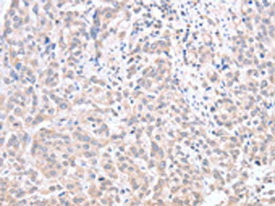 The image on the left is immunohistochemistry of paraffin-embedded Human esophagus cancer tissue using CSB-PA097487(ACOT1 Antibody) at dilution 1/30, on the right is treated with fusion protein. (Original magnification: ×200)