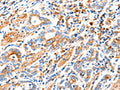 The image on the left is immunohistochemistry of paraffin-embedded Human gastic cancer tissue using CSB-PA097880(MAP2K2 Antibody) at dilution 1/100, on the right is treated with synthetic peptide. (Original magnification: ×200)