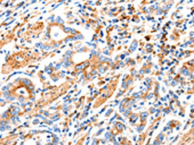 The image on the left is immunohistochemistry of paraffin-embedded Human gastic cancer tissue using CSB-PA097880(MAP2K2 Antibody) at dilution 1/100, on the right is treated with synthetic peptide. (Original magnification: ×200)