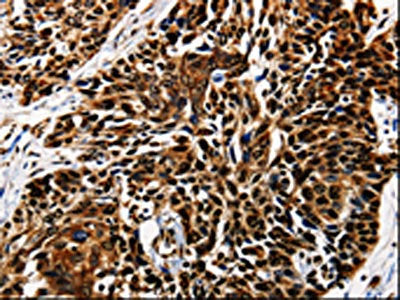 The image is immunohistochemistry of paraffin-embedded Human esophagus cancer tissue using CSB-PA098004(AKT1 Antibody) at dilution 1/25. (Original magnification: ×200)