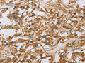 The image on the left is immunohistochemistry of paraffin-embedded Human thyroid cancer tissue using CSB-PA098715(RAD54L2 Antibody) at dilution 1/40, on the right is treated with fusion protein. (Original magnification: ×200)
