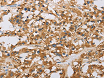 The image on the left is immunohistochemistry of paraffin-embedded Human thyroid cancer tissue using CSB-PA098715(RAD54L2 Antibody) at dilution 1/40, on the right is treated with fusion protein. (Original magnification: ×200)