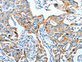 The image on the left is immunohistochemistry of paraffin-embedded Human lung cancer tissue using CSB-PA098902(AFAP1 Antibody) at dilution 1/20, on the right is treated with fusion protein. (Original magnification: ×200)
