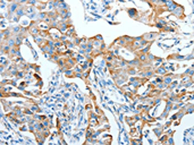 The image on the left is immunohistochemistry of paraffin-embedded Human lung cancer tissue using CSB-PA098902(AFAP1 Antibody) at dilution 1/20, on the right is treated with fusion protein. (Original magnification: ×200)