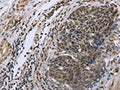 The image on the left is immunohistochemistry of paraffin-embedded Human cervical cancer tissue using CSB-PA098906(FANCG Antibody) at dilution 1/50, on the right is treated with fusion protein. (Original magnification: ×200)