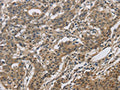 The image on the left is immunohistochemistry of paraffin-embedded Human gastic cancer tissue using CSB-PA099615(DHRS3 Antibody) at dilution 1/30, on the right is treated with fusion protein. (Original magnification: ×200)