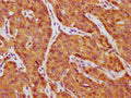 IHC image of CSB-PA09987A0Rb diluted at 1:750 and staining in paraffin-embedded human liver cancer performed on a Leica BondTM system. After dewaxing and hydration, antigen retrieval was mediated by high pressure in a citrate buffer (pH 6.0). Section was blocked with 10% normal goat serum 30min at RT. Then primary antibody (1% BSA) was incubated at 4&deg;C overnight. The primary is detected by a biotinylated secondary antibody and visualized using an HRP conjugated SP system.