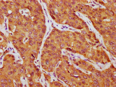 IHC image of CSB-PA09987A0Rb diluted at 1:750 and staining in paraffin-embedded human liver cancer performed on a Leica BondTM system. After dewaxing and hydration, antigen retrieval was mediated by high pressure in a citrate buffer (pH 6.0). Section was blocked with 10% normal goat serum 30min at RT. Then primary antibody (1% BSA) was incubated at 4&deg;C overnight. The primary is detected by a biotinylated secondary antibody and visualized using an HRP conjugated SP system.