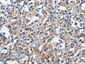 The image on the left is immunohistochemistry of paraffin-embedded Human thyroid cancer tissue using CSB-PA100599(CD244 Antibody) at dilution 1/40, on the right is treated with fusion protein. (Original magnification: ×200)