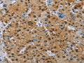The image on the left is immunohistochemistry of paraffin-embedded Human liver cancer tissue using CSB-PA100659(BTLA Antibody) at dilution 1/30, on the right is treated with fusion protein. (Original magnification: ×200)