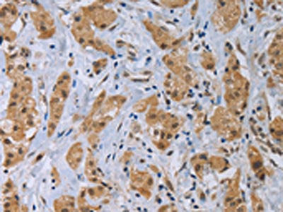 The image on the left is immunohistochemistry of paraffin-embedded Human breast cancer tissue using CSB-PA100844(CLEC1A Antibody) at dilution 1/40, on the right is treated with fusion protein. (Original magnification: ×200)