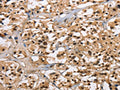 The image on the left is immunohistochemistry of paraffin-embedded Human thyroid cancer tissue using CSB-PA101001(CARD8 Antibody) at dilution 1/30, on the right is treated with fusion protein. (Original magnification: ×200)