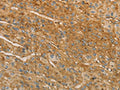 The image on the left is immunohistochemistry of paraffin-embedded Human liver cancer tissue using CSB-PA101139(VTN Antibody) at dilution 1/40, on the right is treated with fusion protein. (Original magnification: ×200)