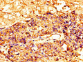 IHC image of CSB-PA10159A0Rb diluted at 1:300 and staining in paraffin-embedded human ovarian cancer performed on a Leica BondTM system. After dewaxing and hydration, antigen retrieval was mediated by high pressure in a citrate buffer (pH 6.0). Section was blocked with 10% normal goat serum 30min at RT. Then primary antibody (1% BSA) was incubated at 4&deg;C overnight. The primary is detected by a biotinylated secondary antibody and visualized using an HRP conjugated SP system.