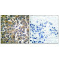 Immunohistochemical analysis of paraffin-embedded human breast carcinoma tissue using FAP-1 antibody.