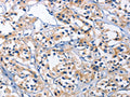 The image on the left is immunohistochemistry of paraffin-embedded Human thyroid cancer tissue using CSB-PA102123(CAPZA2 Antibody) at dilution 1/30, on the right is treated with fusion protein. (Original magnification: ×200)