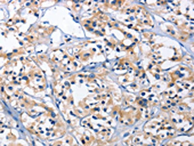 The image on the left is immunohistochemistry of paraffin-embedded Human thyroid cancer tissue using CSB-PA102123(CAPZA2 Antibody) at dilution 1/30, on the right is treated with fusion protein. (Original magnification: ×200)