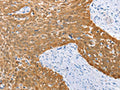 The image on the left is immunohistochemistry of paraffin-embedded Human cervical cancer tissue using CSB-PA102246(IRF6 Antibody) at dilution 1/50, on the right is treated with fusion protein. (Original magnification: ×200)