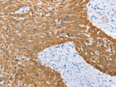 The image on the left is immunohistochemistry of paraffin-embedded Human cervical cancer tissue using CSB-PA102246(IRF6 Antibody) at dilution 1/50, on the right is treated with fusion protein. (Original magnification: ×200)