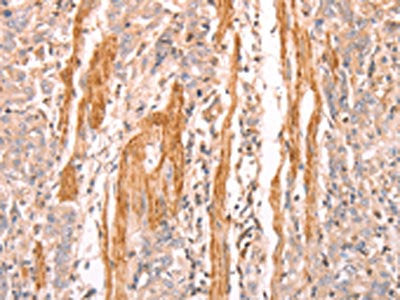 The image on the left is immunohistochemistry of paraffin-embedded Human gastic cancer tissue using CSB-PA102299(INA Antibody) at dilution 1/25, on the right is treated with synthetic peptide. (Original magnification: ×200)