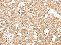 The image on the left is immunohistochemistry of paraffin-embedded Human thyroid cancer tissue using CSB-PA102580(CIAPIN1 Antibody) at dilution 1/60, on the right is treated with fusion protein. (Original magnification: ×200)