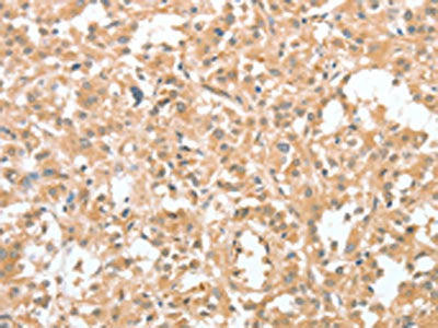 The image on the left is immunohistochemistry of paraffin-embedded Human thyroid cancer tissue using CSB-PA102580(CIAPIN1 Antibody) at dilution 1/60, on the right is treated with fusion protein. (Original magnification: ×200)