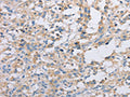 The image on the left is immunohistochemistry of paraffin-embedded Human thyroid cancer tissue using CSB-PA102745(ACTR2 Antibody) at dilution 1/30, on the right is treated with fusion protein. (Original magnification: ×200)