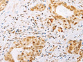 The image on the left is immunohistochemistry of paraffin-embedded Human cervical cancer tissue using CSB-PA102889(SPIN2B Antibody) at dilution 1/25, on the right is treated with fusion protein. (Original magnification: ×200)