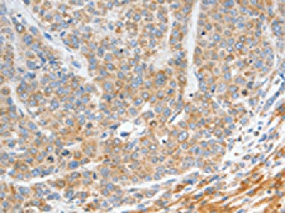 The image on the left is immunohistochemistry of paraffin-embedded Human gastic cancer tissue using CSB-PA103023(NTS Antibody) at dilution 1/20, on the right is treated with fusion protein. (Original magnification: ×200)