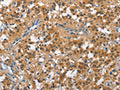 The image on the left is immunohistochemistry of paraffin-embedded Human thyroid cancer tissue using CSB-PA103046(CUL7 Antibody) at dilution 1/50, on the right is treated with fusion protein. (Original magnification: ×200)