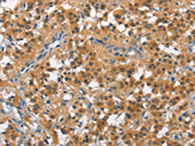 The image on the left is immunohistochemistry of paraffin-embedded Human thyroid cancer tissue using CSB-PA103046(CUL7 Antibody) at dilution 1/50, on the right is treated with fusion protein. (Original magnification: ×200)