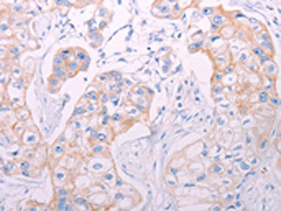 The image on the left is immunohistochemistry of paraffin-embedded Human breast cancer tissue using CSB-PA103066(ADAMTS14 Antibody) at dilution 1/50, on the right is treated with synthetic peptide. (Original magnification: ×200)