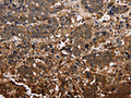 The image on the left is immunohistochemistry of paraffin-embedded Human liver cancer tissue using CSB-PA103410(FBP2 Antibody) at dilution 1/40, on the right is treated with fusion protein. (Original magnification: ×200)