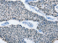 The image on the left is immunohistochemistry of paraffin-embedded Human lung cancer tissue using CSB-PA104194(ELAVL1 Antibody) at dilution 1/50, on the right is treated with fusion protein. (Original magnification: ×200)