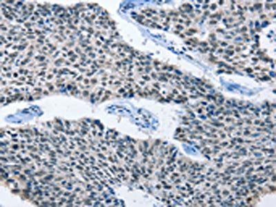 The image on the left is immunohistochemistry of paraffin-embedded Human lung cancer tissue using CSB-PA104194(ELAVL1 Antibody) at dilution 1/50, on the right is treated with fusion protein. (Original magnification: ×200)