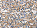 The image on the left is immunohistochemistry of paraffin-embedded Human thyroid cancer tissue using CSB-PA104246(ALCAM Antibody) at dilution 1/15, on the right is treated with synthetic peptide. (Original magnification: ×200)