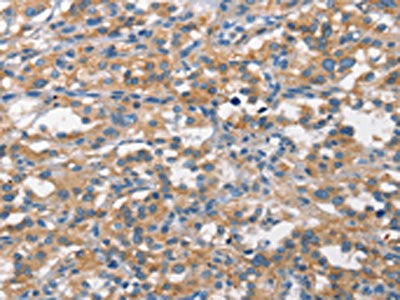 The image on the left is immunohistochemistry of paraffin-embedded Human thyroid cancer tissue using CSB-PA104246(ALCAM Antibody) at dilution 1/15, on the right is treated with synthetic peptide. (Original magnification: ×200)