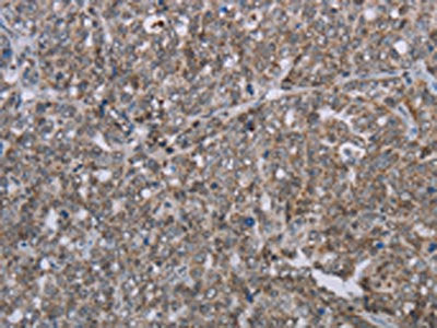 The image on the left is immunohistochemistry of paraffin-embedded Human ovarian cancer tissue using CSB-PA104319(MMP20 Antibody) at dilution 1/30, on the right is treated with synthetic peptide. (Original magnification: ×200)