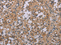 The image on the left is immunohistochemistry of paraffin-embedded Human thyroid cancer tissue using CSB-PA104519(ACVR2A Antibody) at dilution 1/20, on the right is treated with synthetic peptide. (Original magnification: ×200)