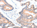 The image on the left is immunohistochemistry of paraffin-embedded Human colon cancer tissue using CSB-PA104599(AOC1 Antibody) at dilution 1/15, on the right is treated with fusion protein. (Original magnification: ×200)