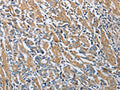 The image on the left is immunohistochemistry of paraffin-embedded Human gastic cancer tissue using CSB-PA104672(RETN Antibody) at dilution 1/20, on the right is treated with fusion protein. (Original magnification: ×200)