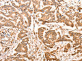 The image on the left is immunohistochemistry of paraffin-embedded Human colon cancer tissue using CSB-PA104784(ACO2 Antibody) at dilution 1/30, on the right is treated with synthetic peptide. (Original magnification: ×200)