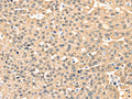 The image on the left is immunohistochemistry of paraffin-embedded Human ovarian cancer tissue using CSB-PA105671(MAP2K3 Antibody) at dilution 1/10, on the right is treated with fusion protein. (Original magnification: ×200)